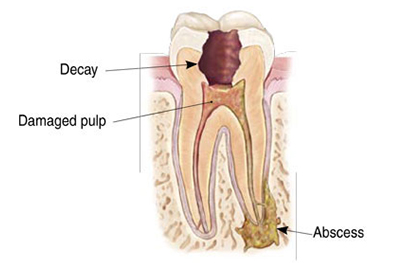 Dental cross-section showing tooth decay, damaged pulp, and abscess formation.