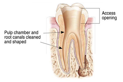 Dental cross-section diagram showing root canal treatment with pulp chamber cleaning and access opening labeled.