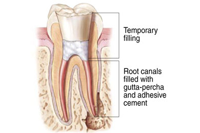 Dental cross-section showing temporary filling and root canals filled with gutta-percha and adhesive cement.