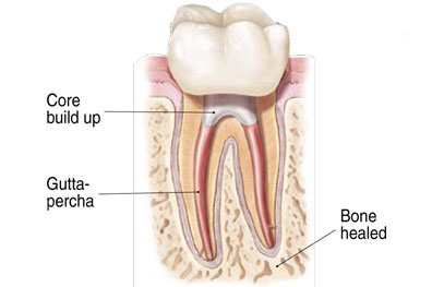 Dental root canal anatomy diagram showing tooth cross-section with core buildup, gutta-percha, and bone healing stages.