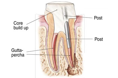 Dental cross-section diagram showing tooth structure with core buildup, posts, and gutta-percha for endodontic treatment.