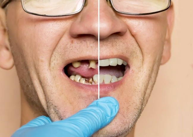 Dentist examining patient's teeth and gums with gloved hand during oral examination.