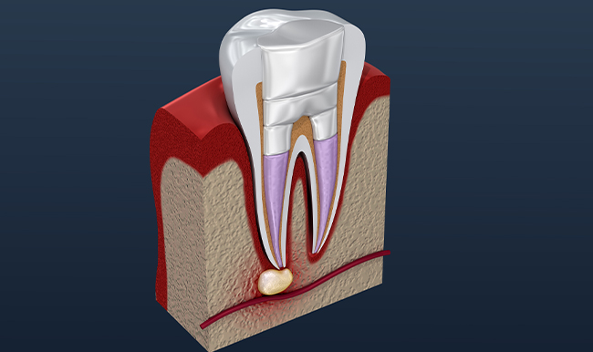 Cross-section diagram of tooth anatomy showing crown, root, and internal pulp structure.