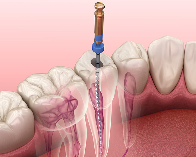 Dental root canal procedure visualization showing endodontic treatment with instrument accessing tooth pulp chamber.