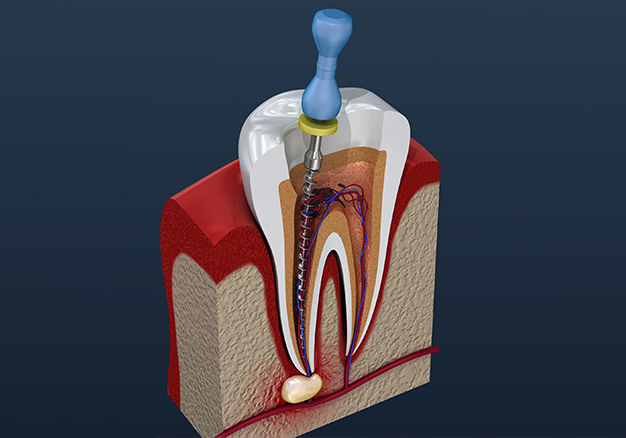 Cross-section diagram of tooth anatomy showing internal structure, pulp chamber, and root canal system.