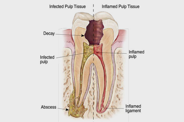 Diagram showing infected and inflamed tooth pulp tissue with decay, abscess, and infection labeled.