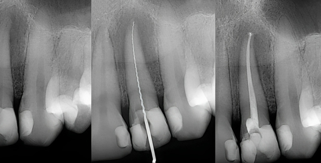 Dental X-rays showing three tooth cross-sections with root canal treatment procedures and endodontic files.