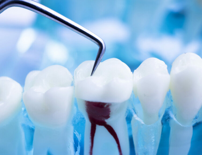 Dental model showing tooth with red root canal highlighted among white teeth models on blue background.
