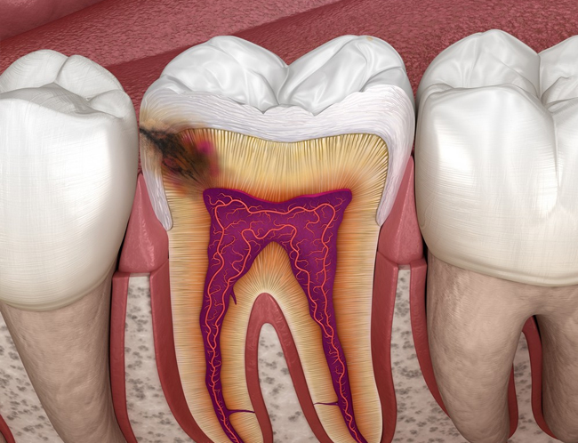 Dental cross-section diagram showing tooth anatomy with pulp chamber, nerves, and root canal structure.