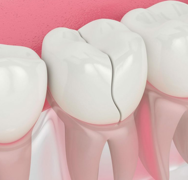Digital illustration of dental crown placement on tooth with gum tissue against pink background.